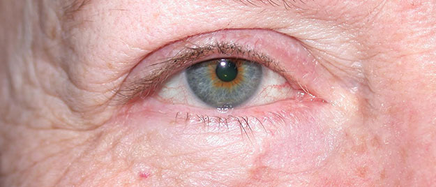 Eyelid reconstruction