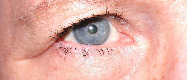 Eyelid reconstruction