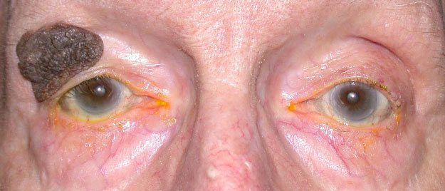 Eyelid reconstruction