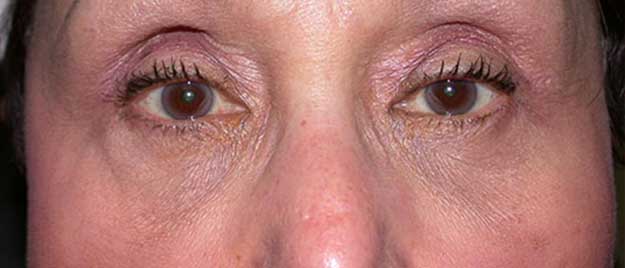 Blepharoplasty
