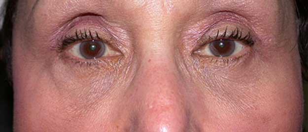 Blepharoplasty