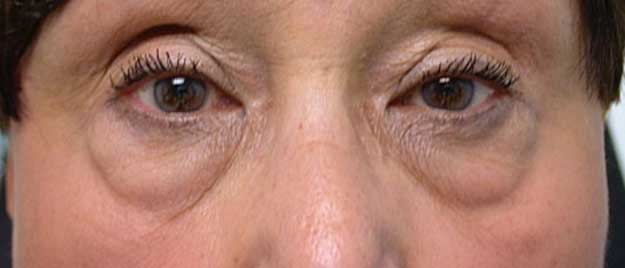 Blepharoplasty