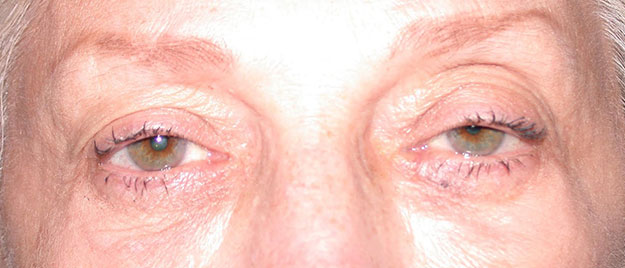 Ptosis Repair Edison