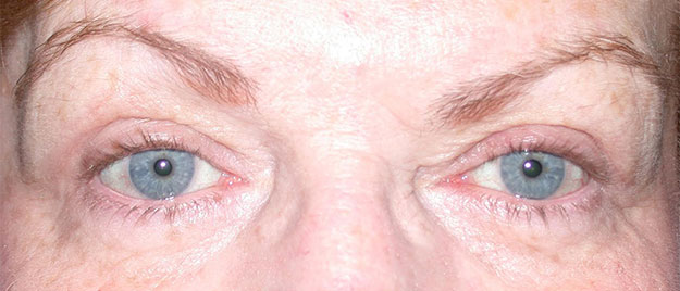 Blepharoplasty Edison