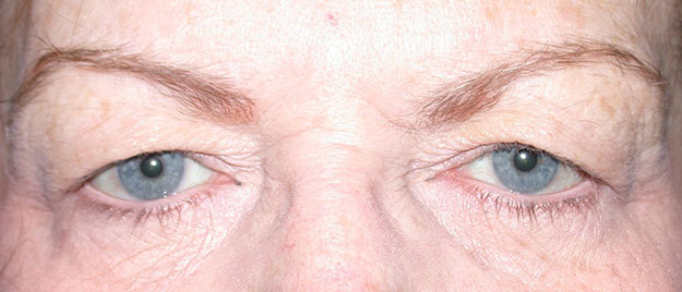 Blepharoplasty Edison