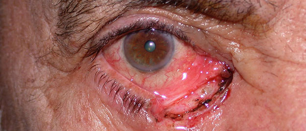 Eyelid reconstruction