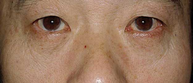 Blepharoplasty