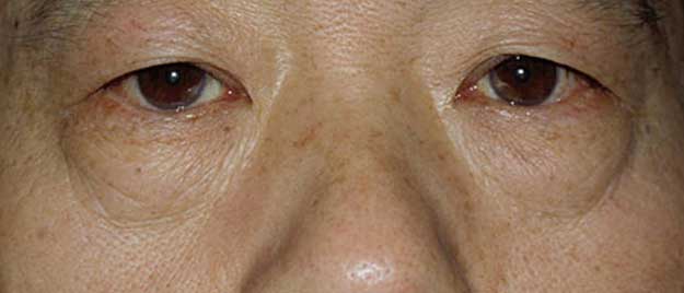 Blepharoplasty