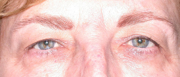 Ptosis Repair Edison