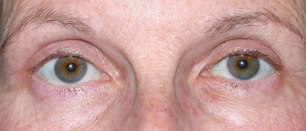 Blepharoplasty Edison