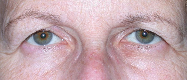 Blepharoplasty Edison