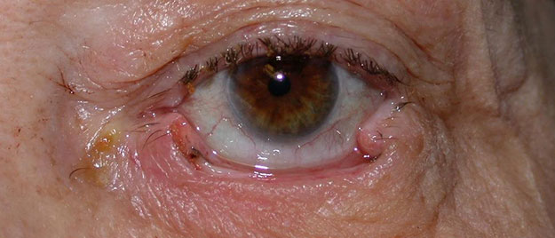 Eyelid reconstruction