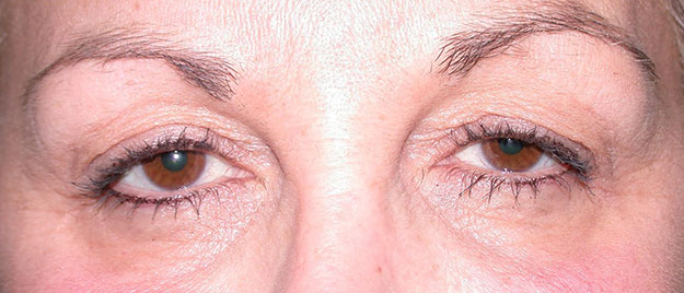 Ptosis Repair Edison