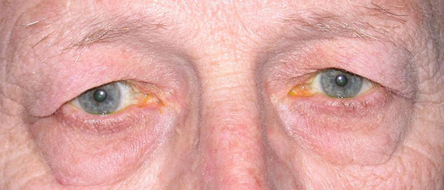 Blepharoplasty Edison