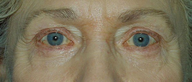 Blepharoplasty