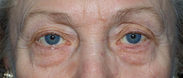 Blepharoplasty