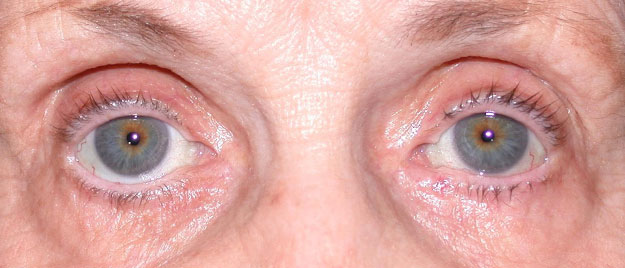 Upper Lid Ptosis, Entropion Repair