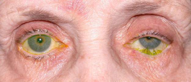 pper Lid Ptosis, Entropion Repair