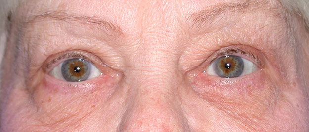 Ptosis Repair Edison