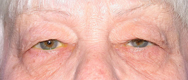 Ptosis Repair Edison