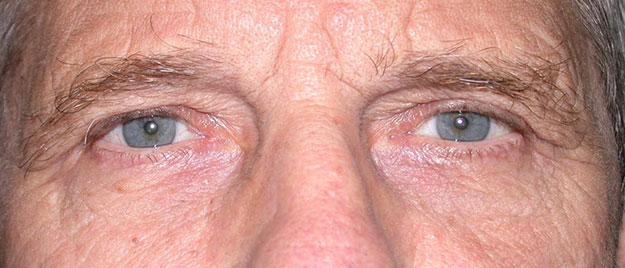 Blepharoplasty Edison