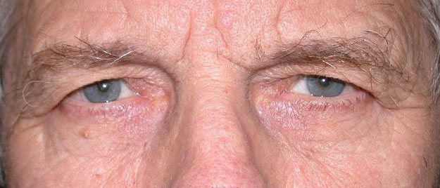 Blepharoplasty Edison