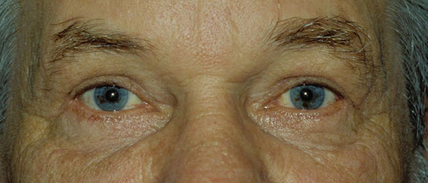 Blepharoplasty