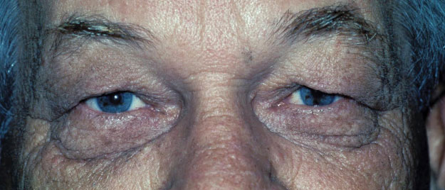 Blepharoplasty