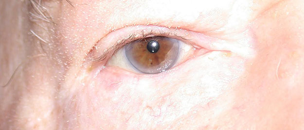 Eyelid reconstruction