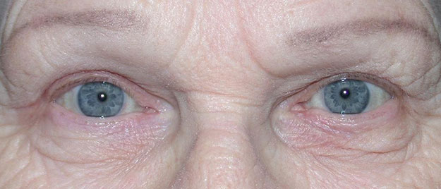 Ptosis Repair Edison