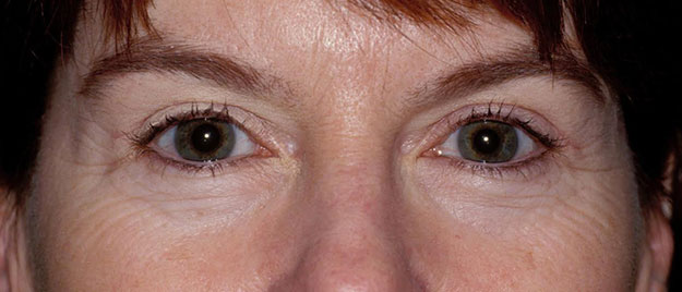 Blepharoplasty Edison