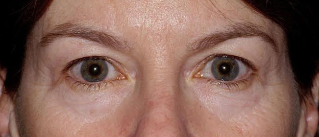 Blepharoplasty Edison