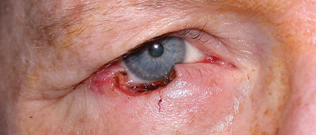 Eyelid reconstruction