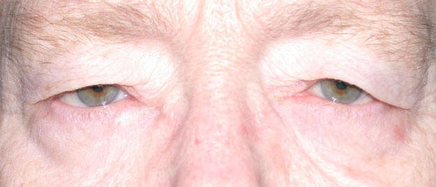 Ptosis Repair