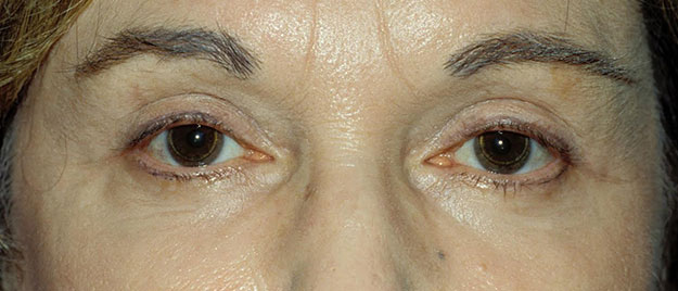 Blepharoplasty Edison