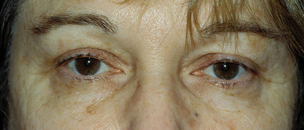 Blepharoplasty Edison