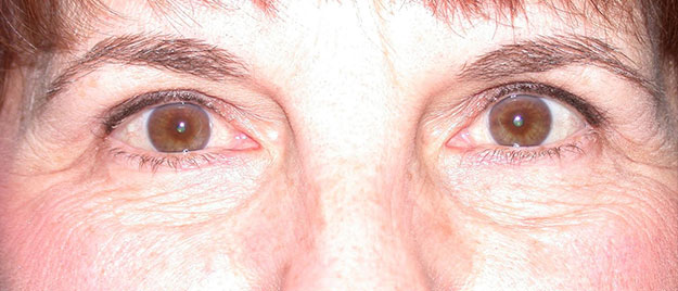 Blepharoplasty Edison