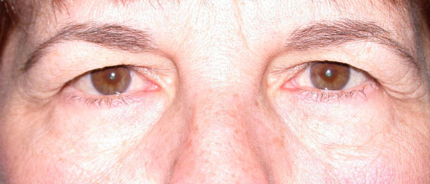 Blepharoplasty Edison