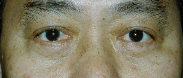 Blepharoplasty