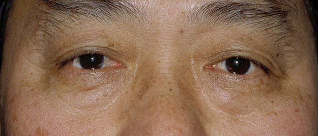 Blepharoplasty