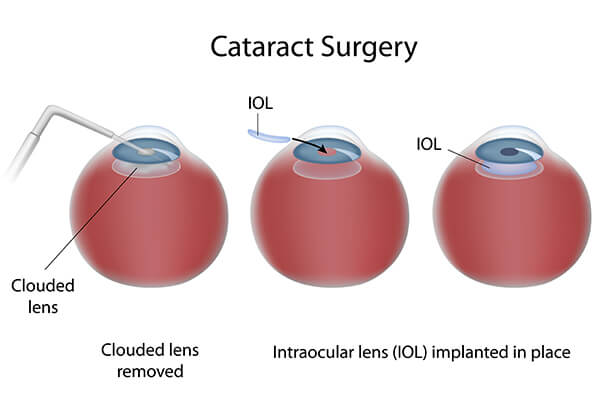 Cataract Surgery Edison